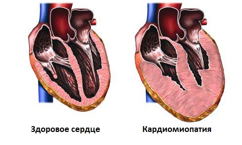 вторичная кардиомиопатия