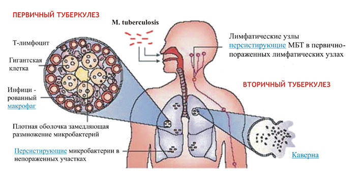 симптомы туберкулеза